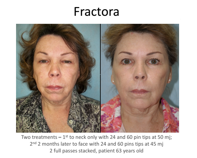 SUNSHINE COSMETIC CLINIC & MEDI SPA Fractora