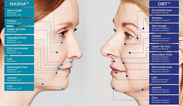 Restylane dermal fillers-where to use