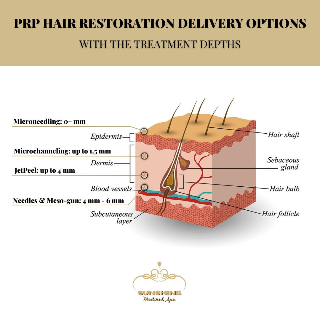 Different delivery options and their treatment depths for PRP hair restoration in Kitchener Waterloo area, Ontario.