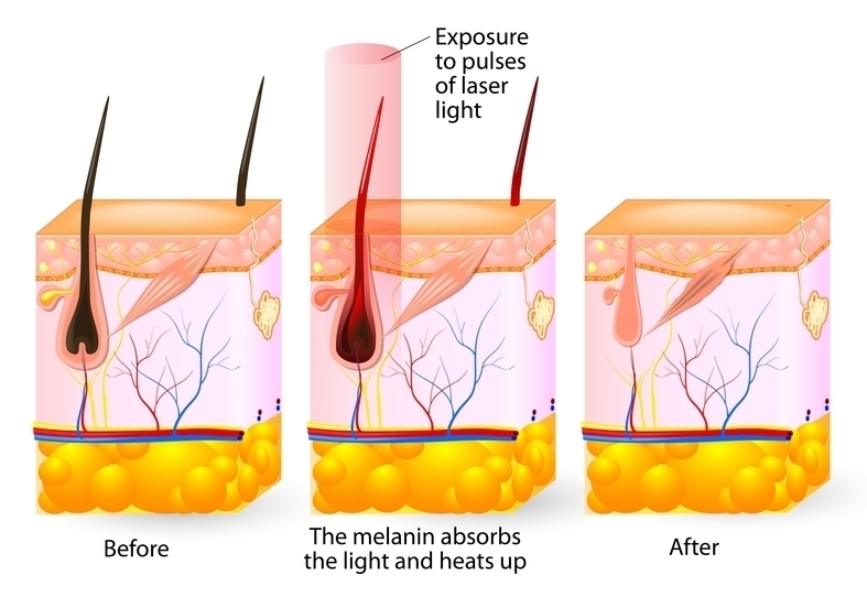 How laser hair removal works
