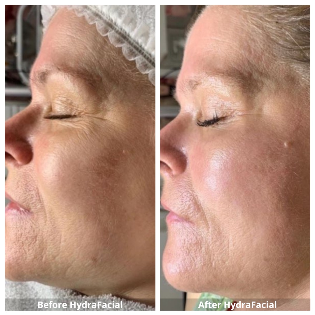 HydraFacial Waterloo & Kitchener