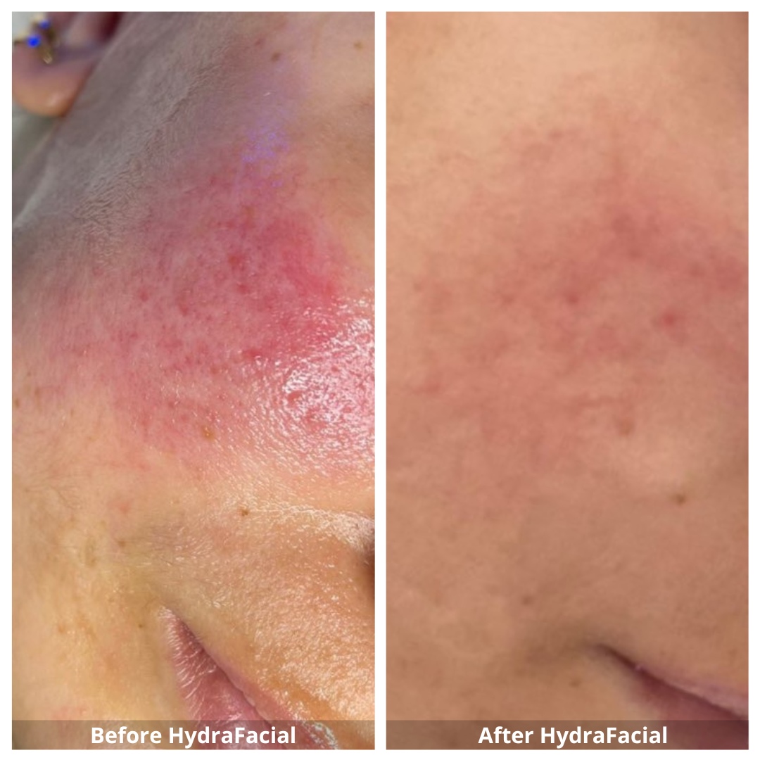 HydraFacial Waterloo & Kitchener