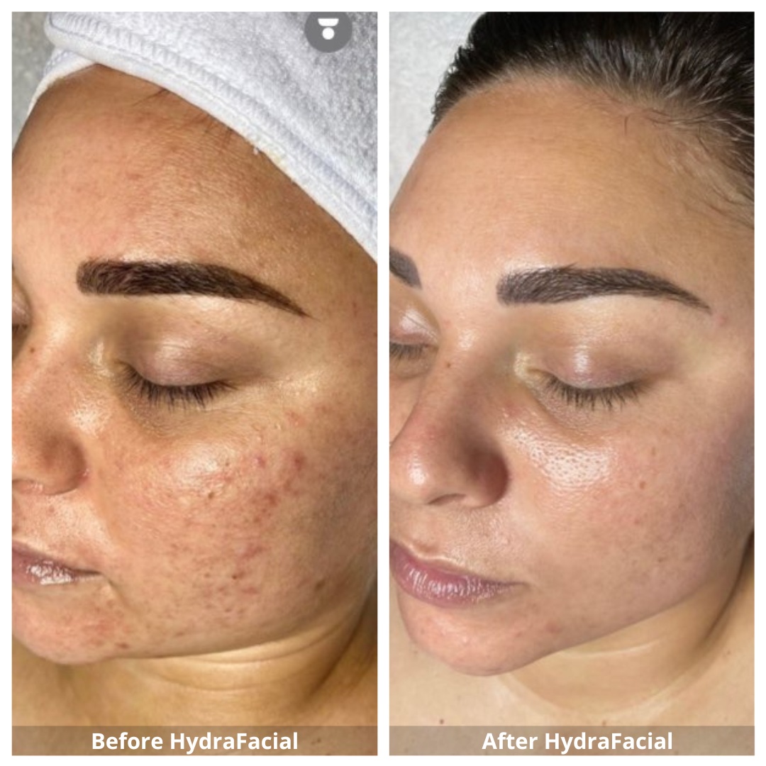 HydraFacial Waterloo & Kitchener