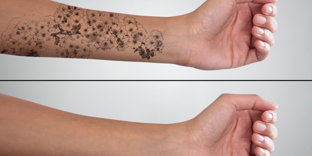 tattoo removal treatment