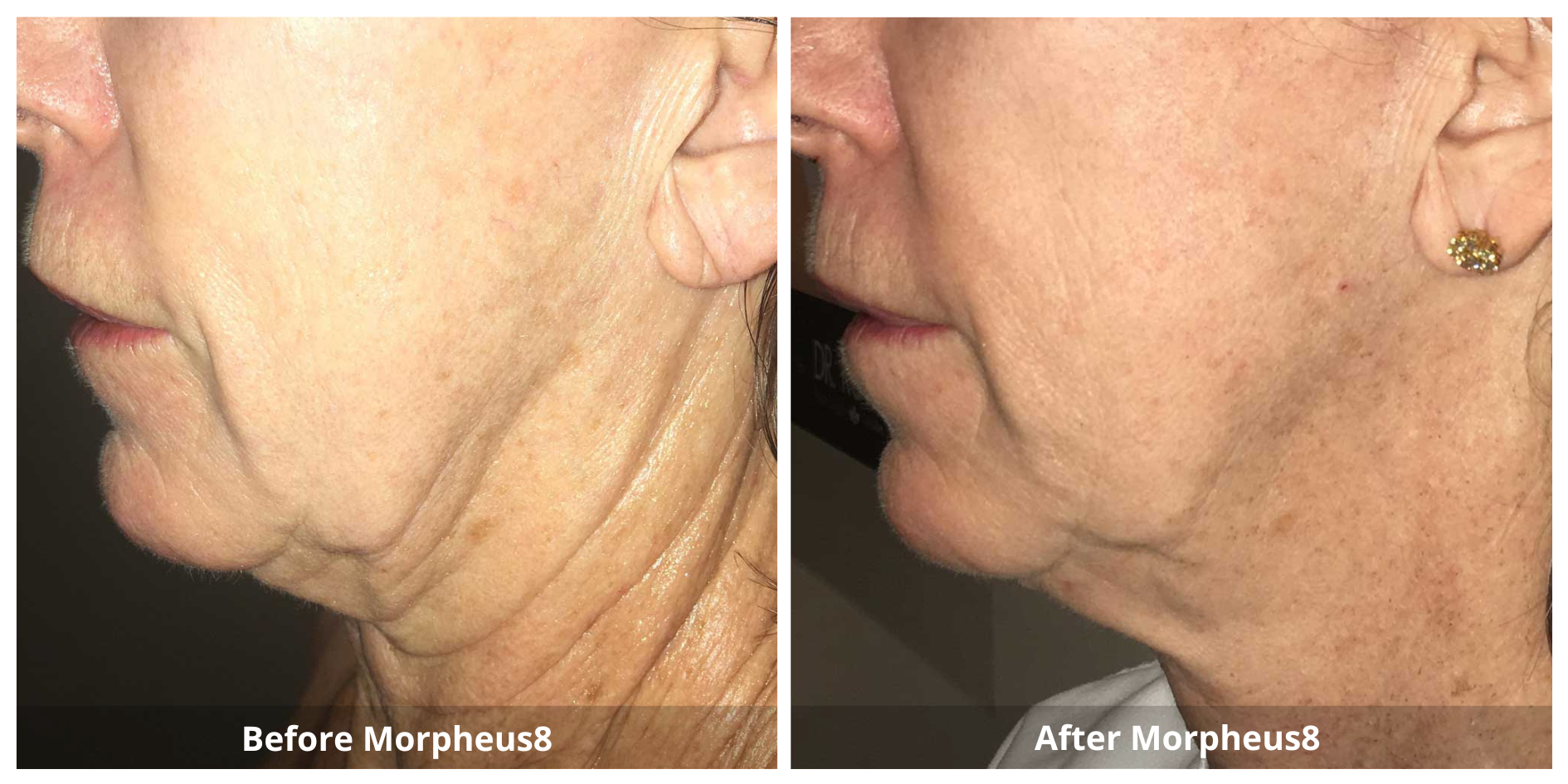 Morpheus8 Neck Treatment Before and After photo