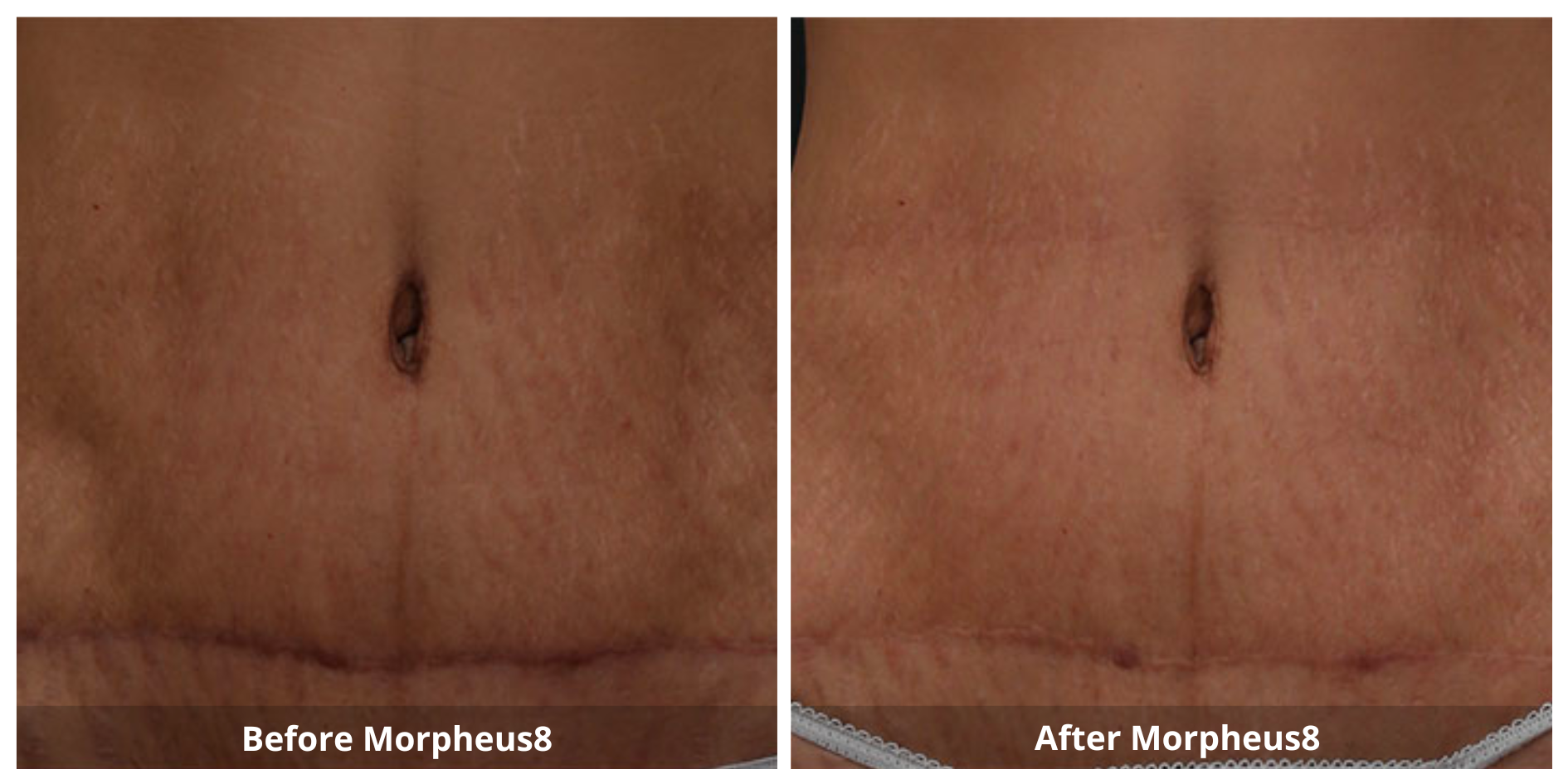 Morpheus8 Stretch Marks and Scar Treatment Before and After photo