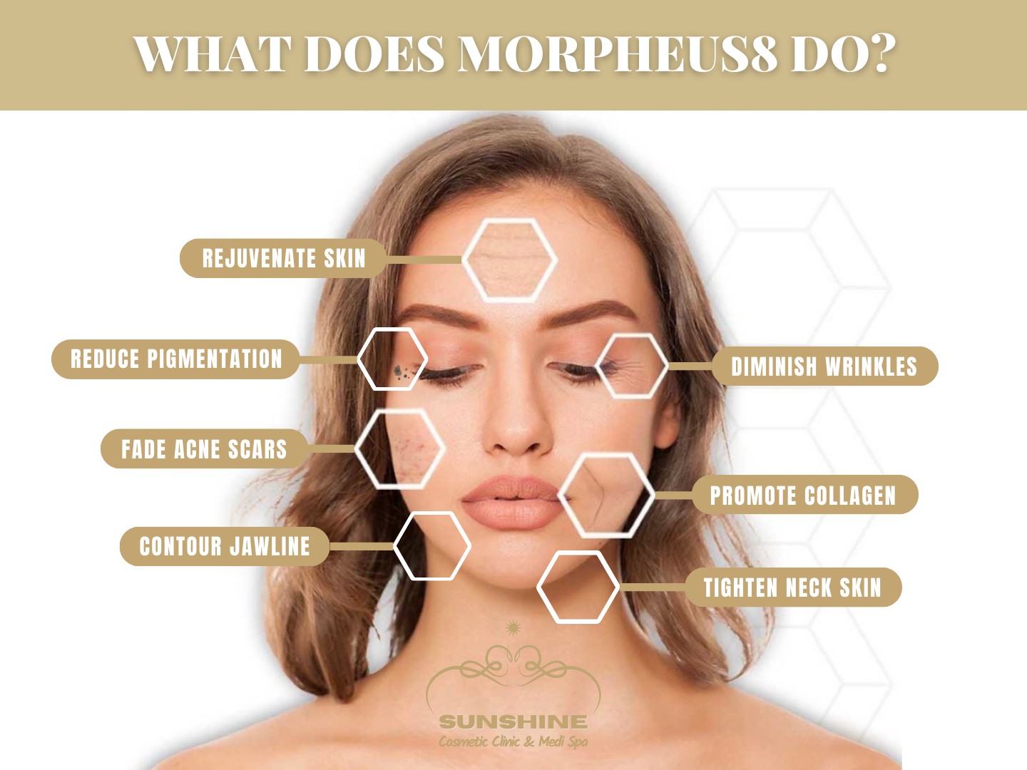 What does Morpheus8 do? Explained by Morpheus8 expert in Kitchener Waterloo area